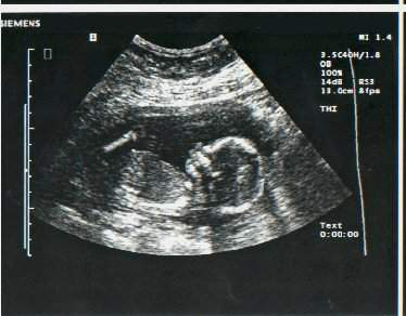 This image shows approximately what a standard ultrasound will display. From an image such as this, a doctor can observe noticeable abnormalities and often determine gender.
