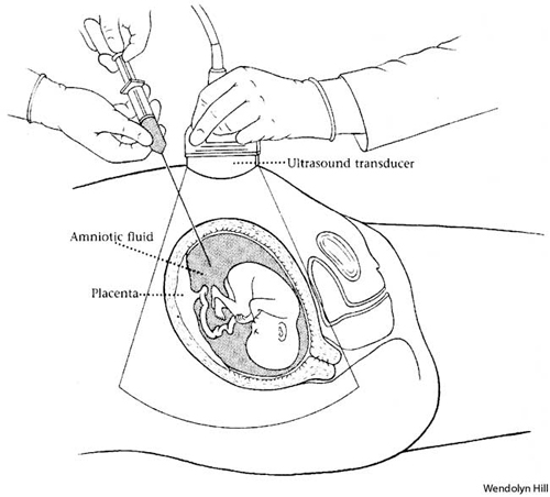 This image shows a basic breakdown of what an amniotic fluid retrieval for analysis would entail.